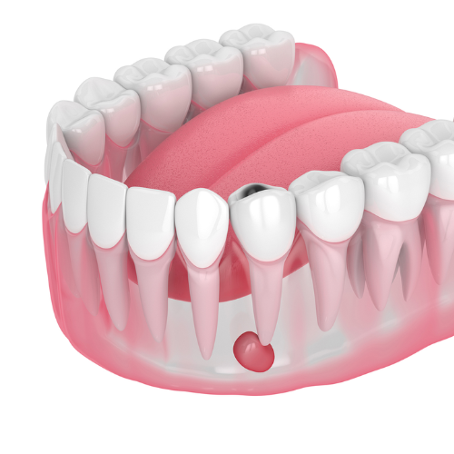 Abscess or Infection