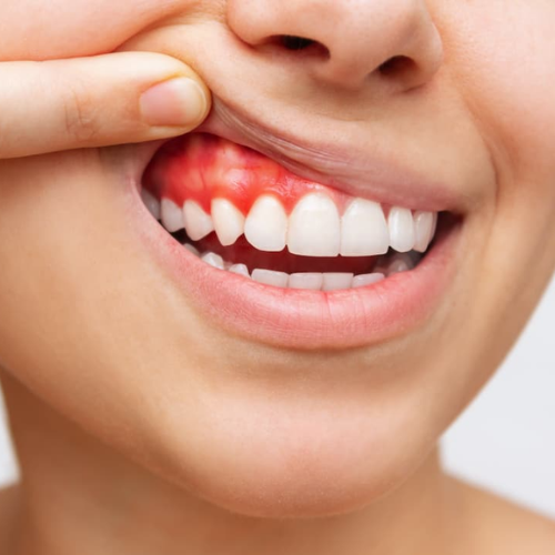 Swollen or Bleeding Gums - Dental Emergency Sign