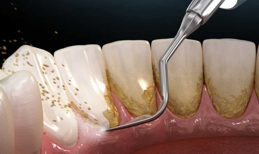 Unveiling Dental Plaque and How to Blast it Away
