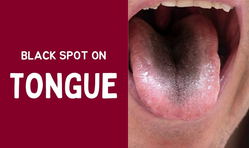 causes black spots on the tongue