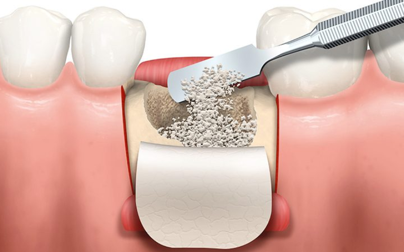 How Long The Bone Grafting Recovery Takes