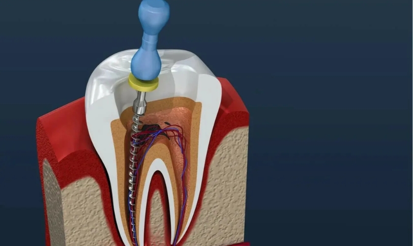 Root Canals